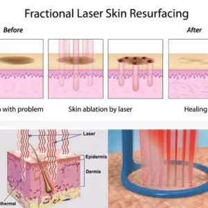 Aparat Laser Fractional Co2 Glass 10600nm, lifting, rejuvenare faciala, skin resurfacing, indepartare vergeturi7, cicatrici, anti acnee, intretinere si rejuvenare vaginala - imagine 3