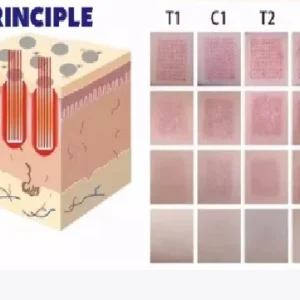 Aparat Laser Fractional Co2 Glass 10600nm, lifting, rejuvenare faciala, skin resurfacing, indepartare vergeturi7, cicatrici, anti acnee, intretinere si rejuvenare vaginala - imagine 4