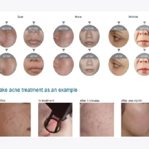 Aparat Laser Fractional Co2 Glass 10600nm, lifting, rejuvenare faciala, skin resurfacing, indepartare vergeturi7, cicatrici, anti acnee, intretinere si rejuvenare vaginala - imagine 5